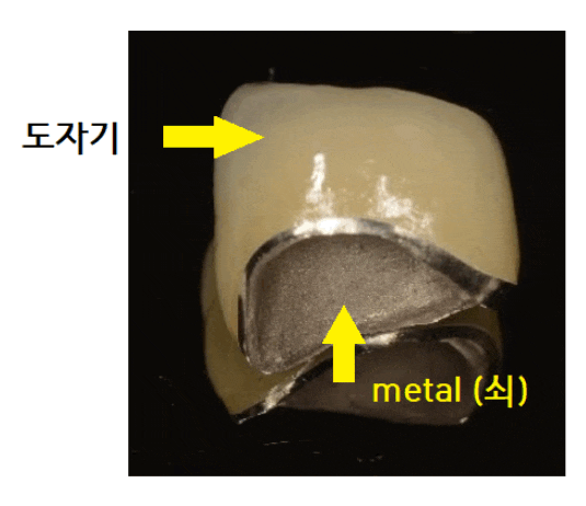 건강보험 임플란트 지르코니아 크라운 확대 길동 치과에서! 관련 이미지 1