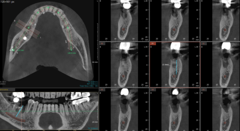 미사역 임플란트 잇몸이 풍선처럼 부풀어오르는 치주농양 환자분 관련 이미지 4