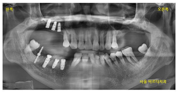 길동 치과 임플란트 뼈이식 후 흡연 상관 있을까? 관련 이미지 7