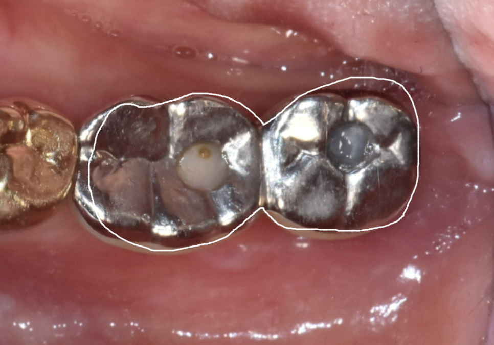 천호동 임플란트 재식립 사례, 평생 쓰는 줄 알았는데? 관련 이미지 8