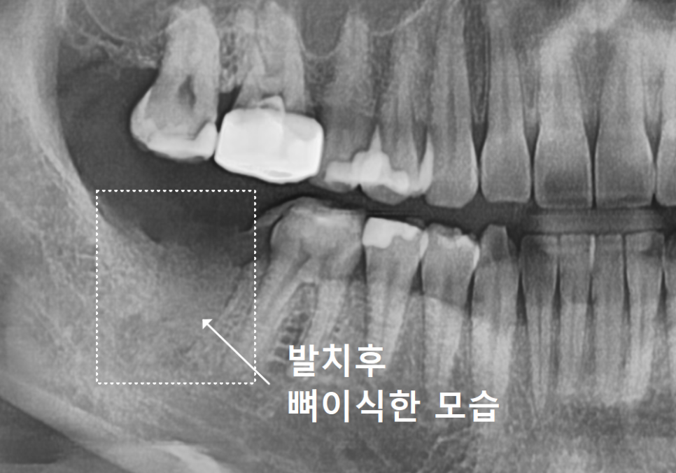 강동구 임플란트 기간, 사람마다 왜 다를까? 즉시식립과 지연식립의 결정적 차이 관련 이미지 8