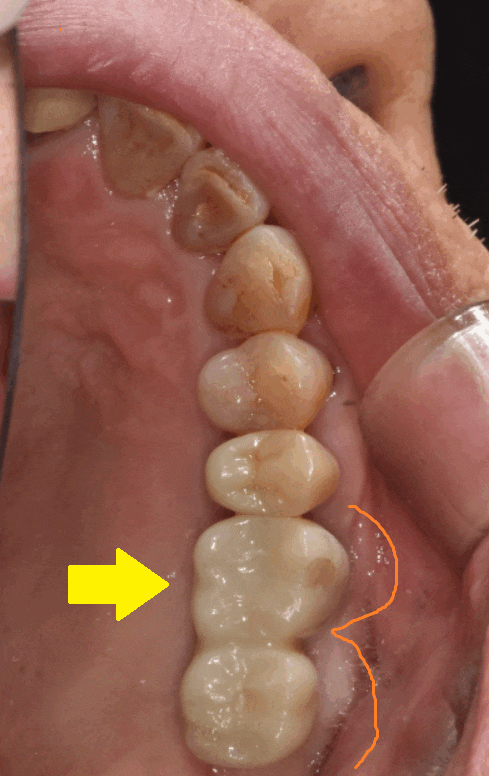 상일동 임플란트 치아 솟음으로 불편함을 느낄 때 관련 이미지 1
