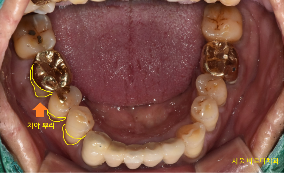 명일역 치과 움직이는 치아 치료 고정할 수 있을까? 관련 이미지 3