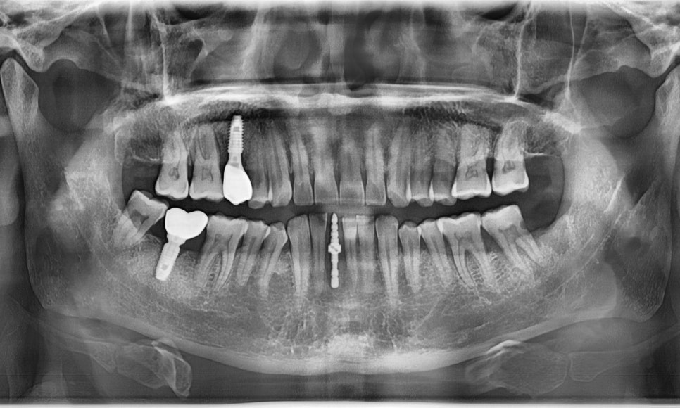 My Teeth Are Shaking So Much That Eating Is Uncomfortable—Is It Okay to Just Leave Them Alone? image 9