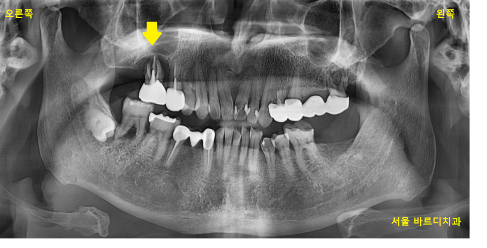명일역 근처 치과 치아 뿌리 염증이 생겨서 고생하신 사연 관련 이미지 2