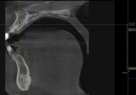 대문니 빠짐, 앞니 빠졌을 때 브릿지와 임플란트 중 나에게 맞는 선택은? 관련 이미지 8