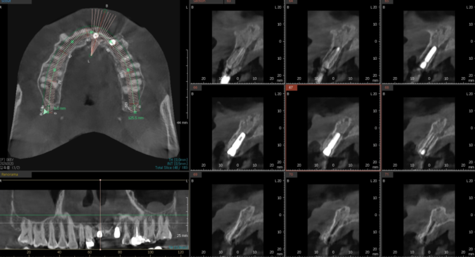 오래된 앞니 크라운 냄새, 관련 이미지 9