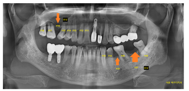 고덕역 근처 치과 브릿지와 임플란트 고민 중이신 분들 클릭하세요 관련 이미지 2
