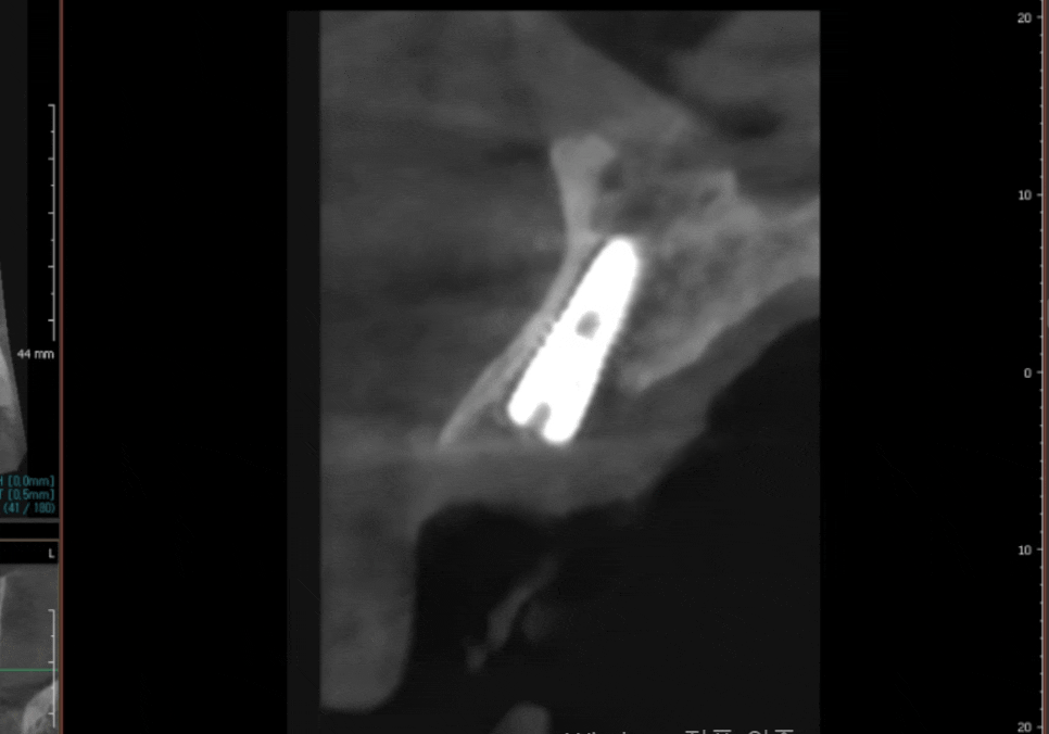 강동구 앞니 충치, 누구는 레진이고 누구는 임플란트인 관련 이미지 16