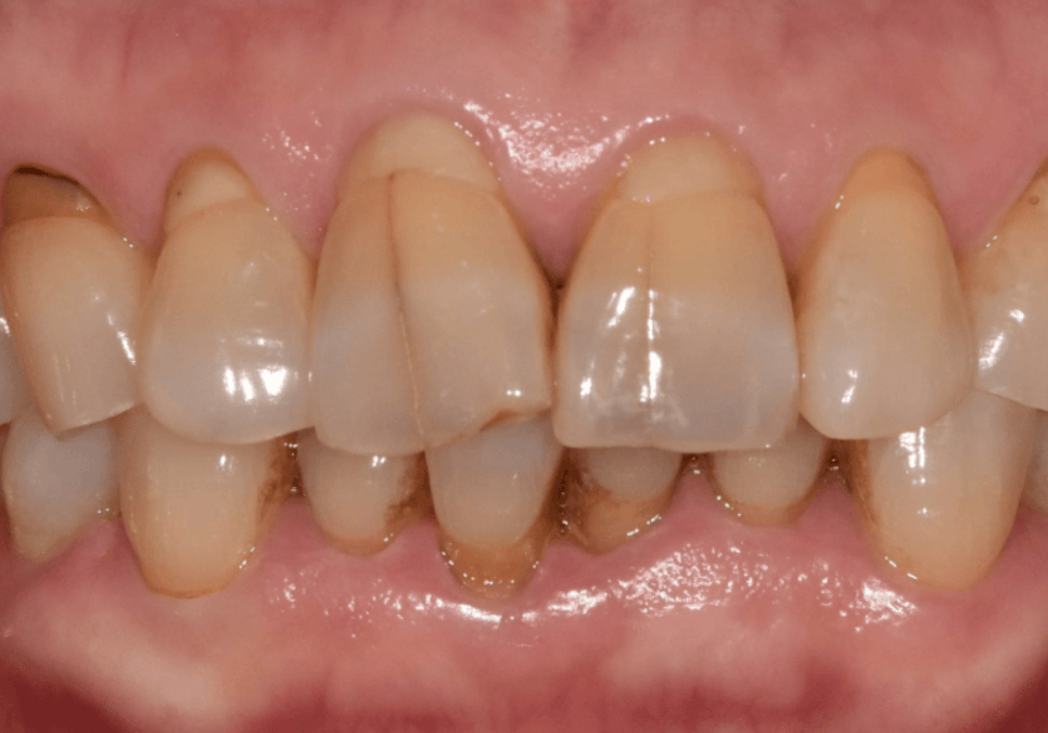 대문니 파절, 앞니에 금이 쩍 갈라졌다면? 딱딱한 음식을 조심해야 하는 이유 관련 이미지 14