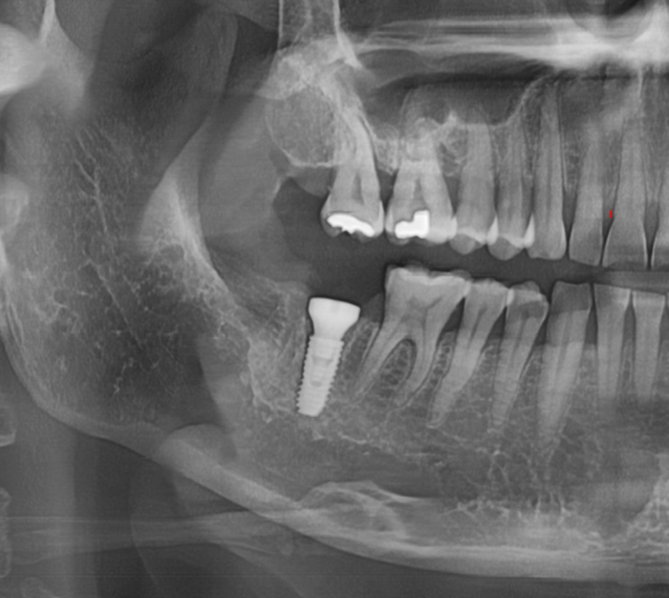 치아 크라운 빠짐 내부 충치가 심할때는 임플란트가 필요합니다. 관련 이미지 7