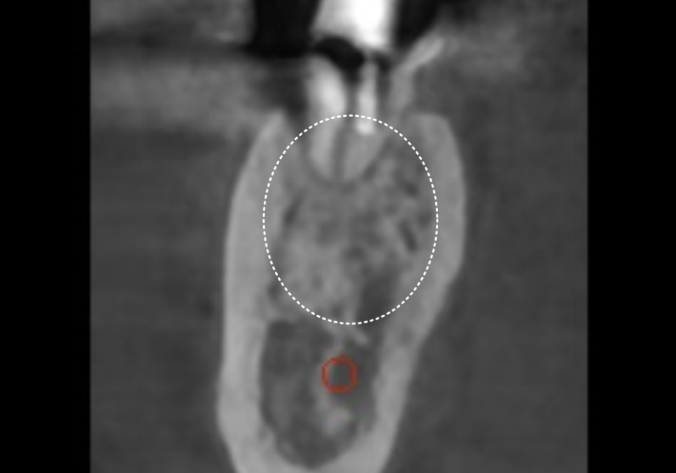 강동구 임플란트 기간, 사람마다 왜 다를까? 즉시식립과 지연식립의 결정적 차이 관련 이미지 14