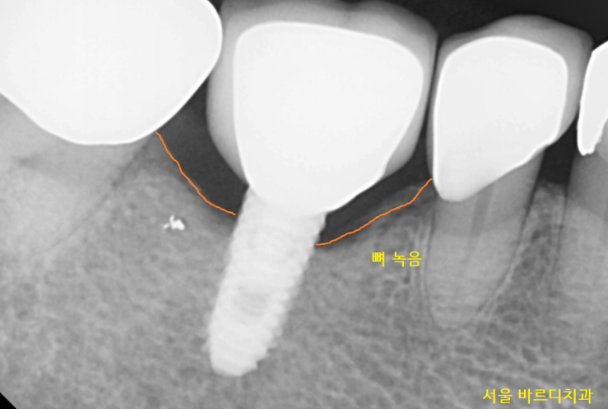 풍산동 치과 임플란트 염증으로 교체 한 환자분 케이스 관련 이미지 2