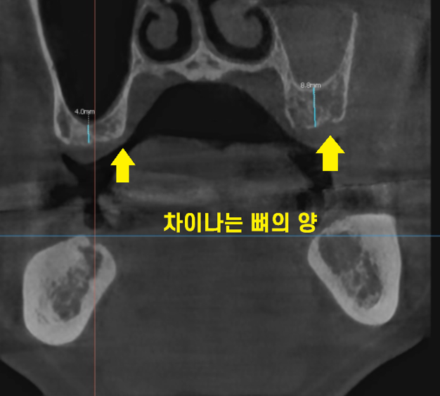 명일동 치과 임플란트 위아래 같이 한꺼번에 할 수 있나요?? 관련 이미지 3