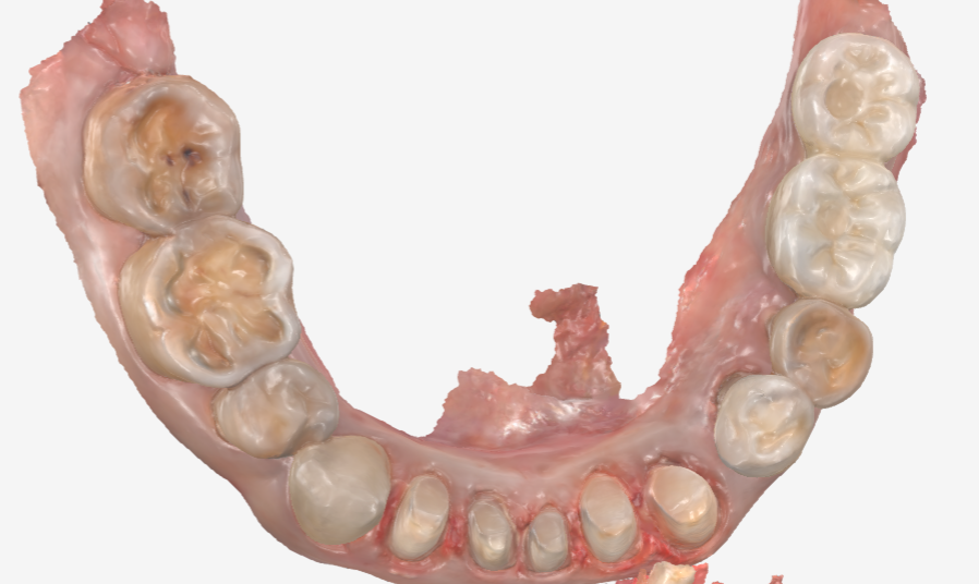 Gangdong-gu Dental Impressions: Are You Still Biting Down for 5 Minutes? We’ll Make It Comfortable with an Intraoral Scanner! image 12