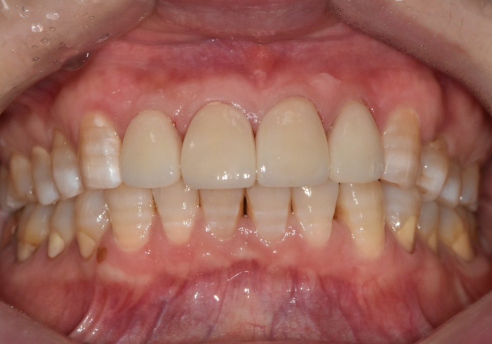 50대 라미네이트, 앞니 벌어짐과 변색 고민 이렇게 해결했습니다. 관련 이미지 9