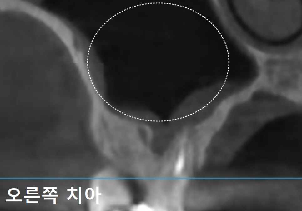 Sinusitis Caused by Teeth: Why Do You Tell Me to Go to the Dentist When My Nose Hurts? image 7