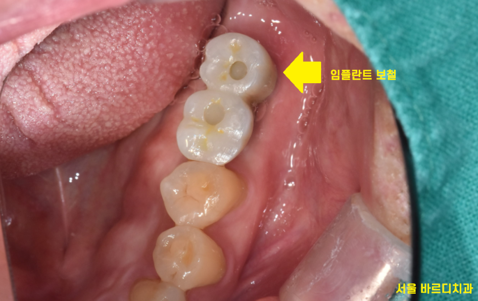 망월동 치과 임플란트 보철 불편 볼 씹힘, 이질감 그 사이에서 관련 이미지 2