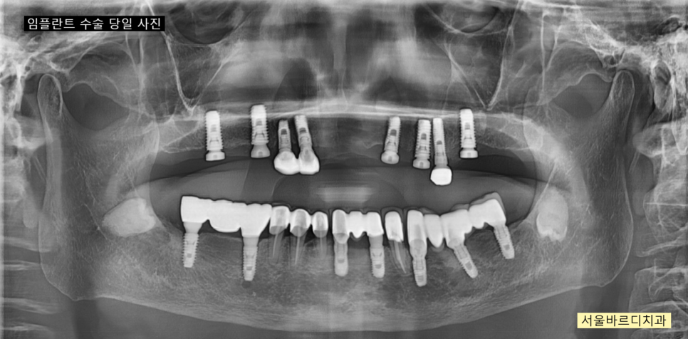 상일동 치과 부분 틀니에서 임플란트 바꿔서 사용하기 관련 이미지 9