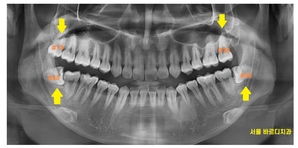상일동 사랑니 발치  시간, 비용 절약하는 3가지 꿀팁 공개~! 관련 이미지 2