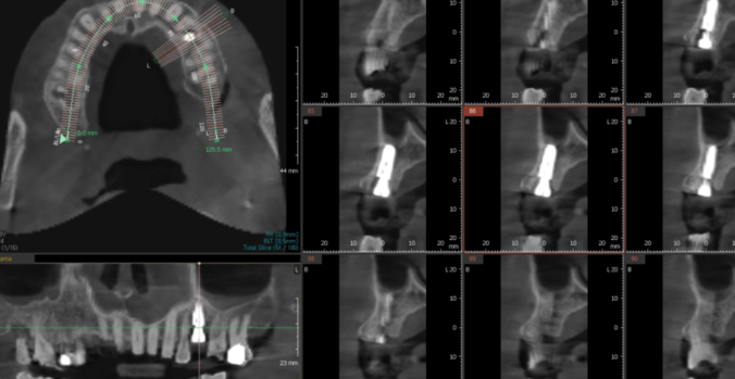 강일동 치과 치아 부러짐 붙일 수 있을까요?? 관련 이미지 9
