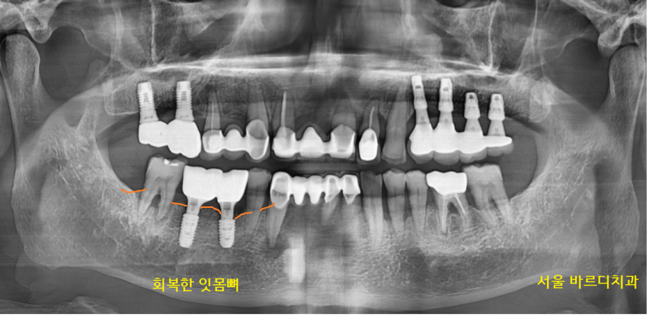 명일역 치과 움직이는 치아 치료 고정할 수 있을까? 관련 이미지 7