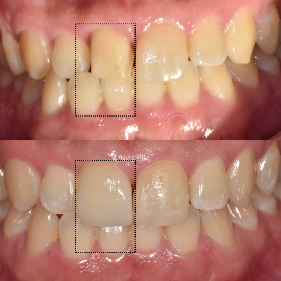 Gangdong-gu laminate failure and detachment: front teeth restored through retreatment image 1