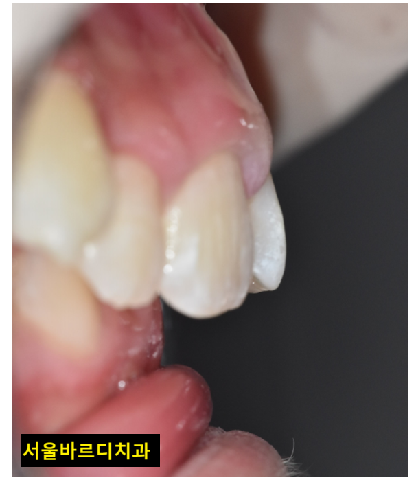 입툭튀 교정 돌출입 수술 없이 가능할까? 관련 이미지 3