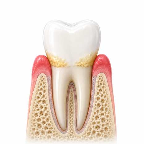 My Teeth Feel More Sensitive After Scaling (+ Causes and Ways to Reduce Sensitivity) image 6