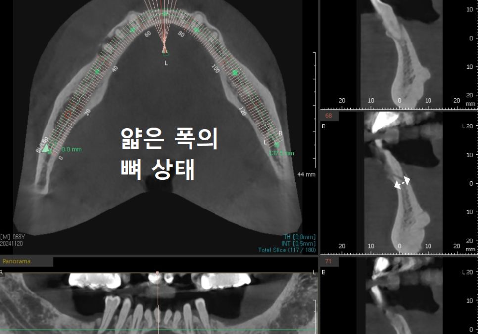 강동구 임플란트 가격 줄이는 방법 2개 발치했는데, 1개만 심어도 된다구요? 관련 이미지 6