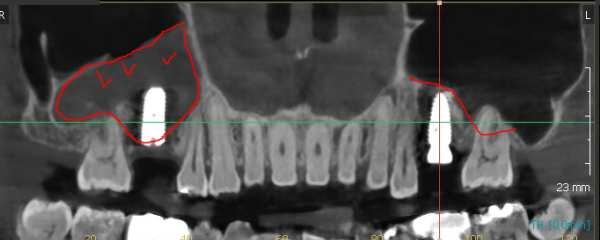 상악동염 이비인후과 치료 후 임플란트를 해야할 수 있습니다. 관련 이미지 5