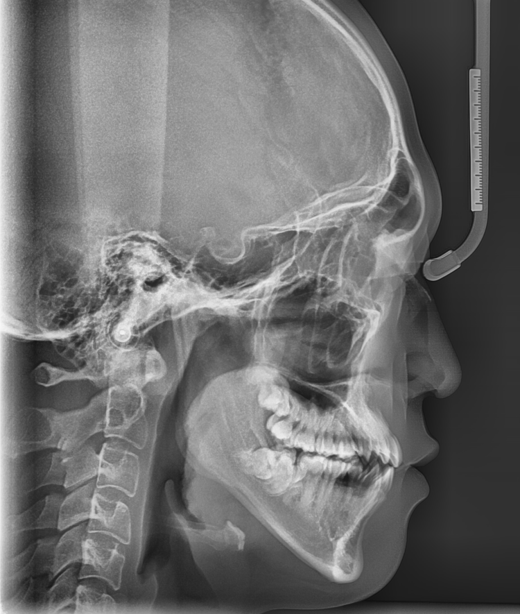 이 안뽑고 교정 안되나요? 발치 교정 케이스를 정리합니다! 관련 이미지 6