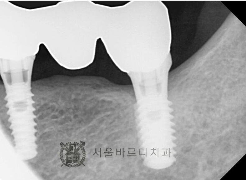 상일동역치과 서울바르디치과 무절개 네비게이션 임플란트 치료증례 #5 관련 이미지 4