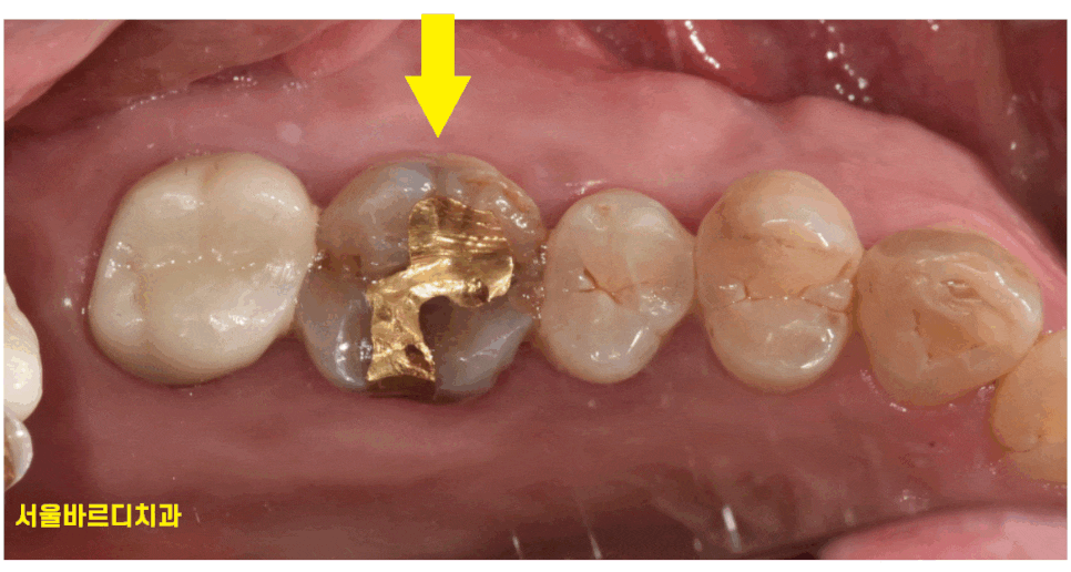 풍산동 치과 골드 인레이 치료했던 치아가 또 충치가 생김. 관련 이미지 1