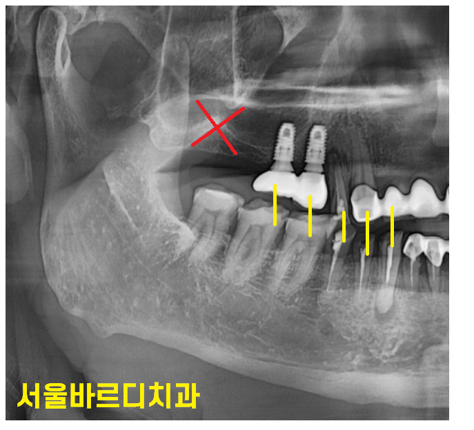 하남 미사 치과 치아 방치하다 올라옴 케이스 보여드립니다. 관련 이미지 3