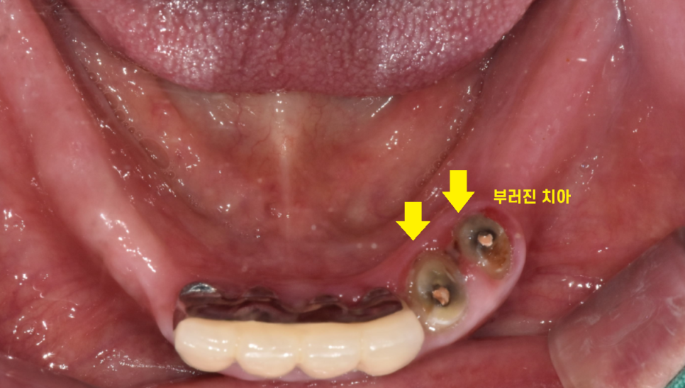 강일동 치과추천 틀니 사용중 치아 부러짐 임플란트로 복구했습니다. 관련 이미지 2