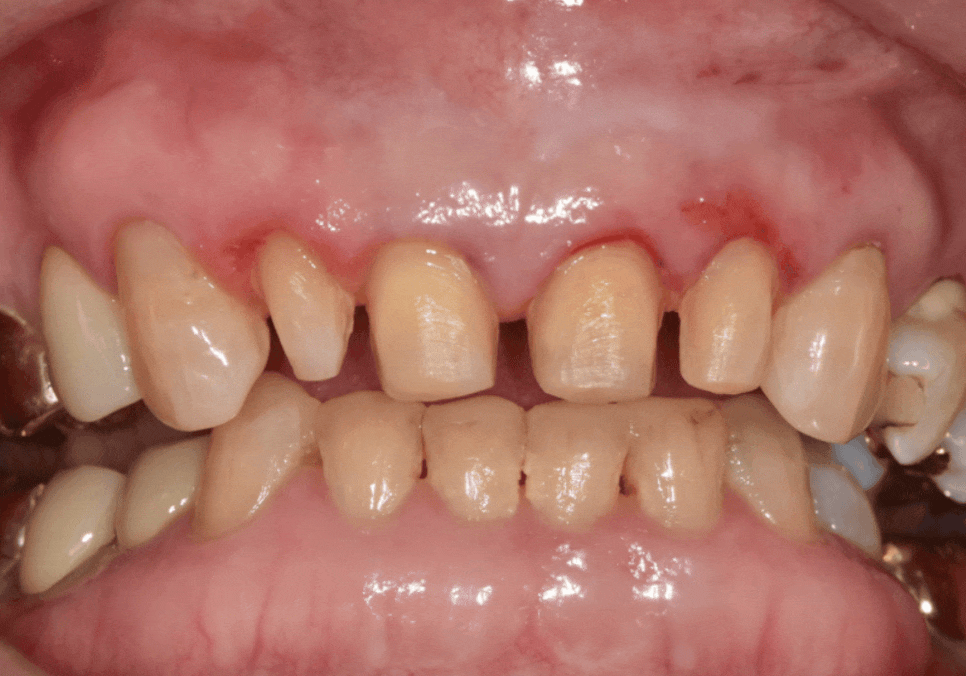 고덕동 무삭제 라미네이트, 실패 없이 하려면 꼭 확인할 3가지 관련 이미지 6