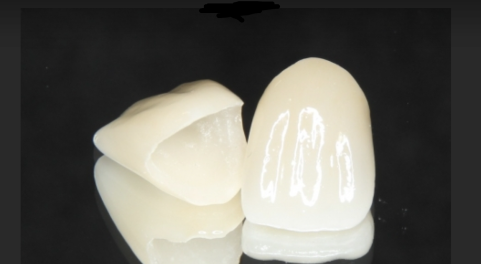 강동구 라미네이트, 치아 하얀 반점 없애고 싶다면? 치료 방법 관련 이미지 10