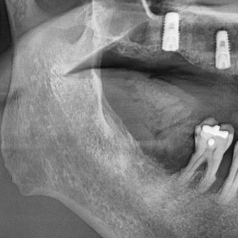 Sangil-dong Dentist: If a Problem Develops with an Implant, Does It Need to Be Replaced? image 6