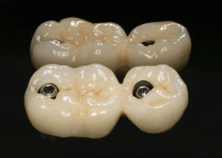 고덕동 임플란트 크라운 연결해서 만드는 이유는? 관련 이미지 1