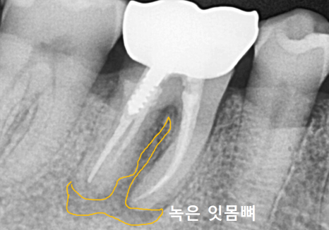강동구 잇몸 여드름, 이런 상태라면 절대 겉에만 짜는 치료 하지 마세요. 관련 이미지 6