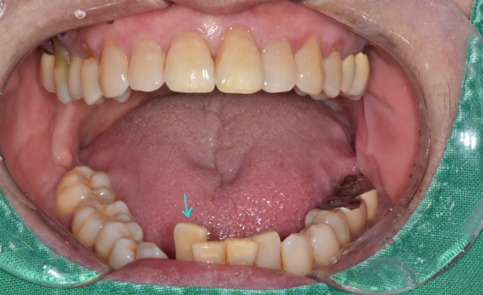 아래 앞니 임플란트 잇몸 염증 고름으로 인한 흔들림이 심해질때 관련 이미지 2