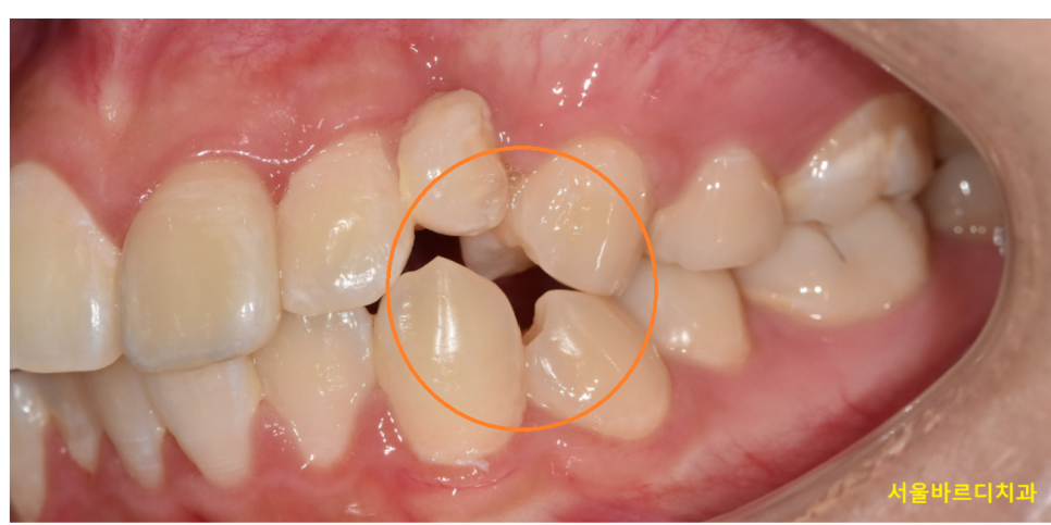 치아 중심선 안맞을 때 걱정스러우신 분들이라면? 관련 이미지 5