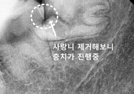 상일동 사랑니 매복 방치하다 옆 치아까지 망가진 실제 사례 관련 이미지 6