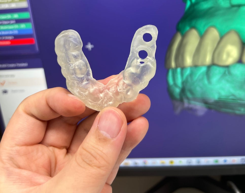 고덕역 치과 위아래 전체 임플란트 디지털을 사용하는 이유? 관련 이미지 6