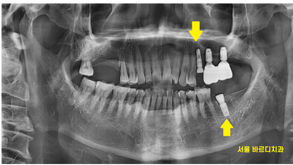 강일동 치과 전남 완도에서 올라오셔서 발치 후 당일 임플란트 완료하였습니다. 관련 이미지 6