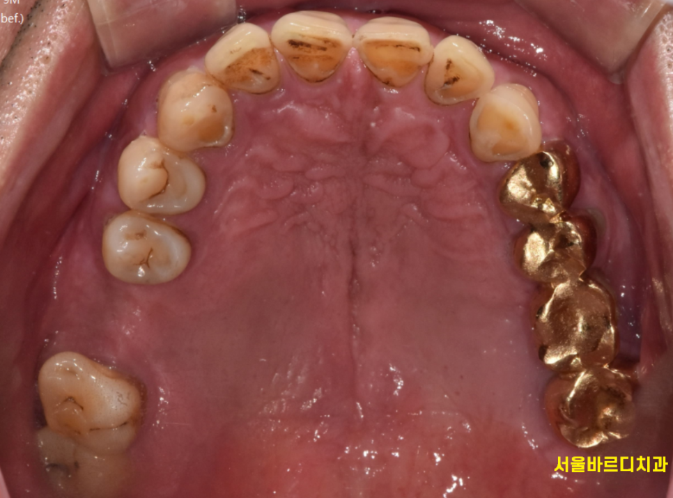 고덕동 치과 검진 시 이게 빠지면 말짱 도루묵!!! 관련 이미지 2