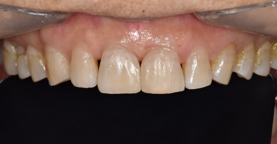 깨지고 벌어진 앞니 사이 레진으로 공간 재분배하였습니다. 관련 이미지 6