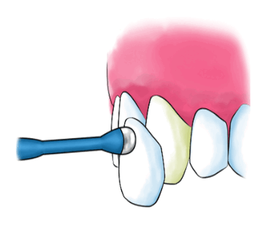 누런니 라미네이트와 미백중 뭐가 더 좋을까요?? 암사동 치과 관련 이미지 1