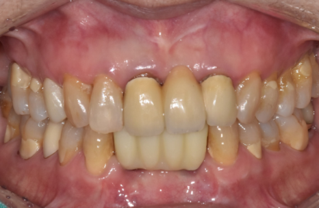 솟구치는 앞니, 흔들리는 치아가 보내는 관련 이미지 15